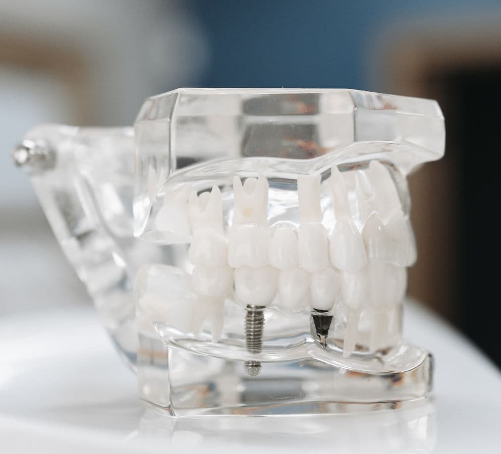 A clear dental model showing a titanium implant post beneath a crown